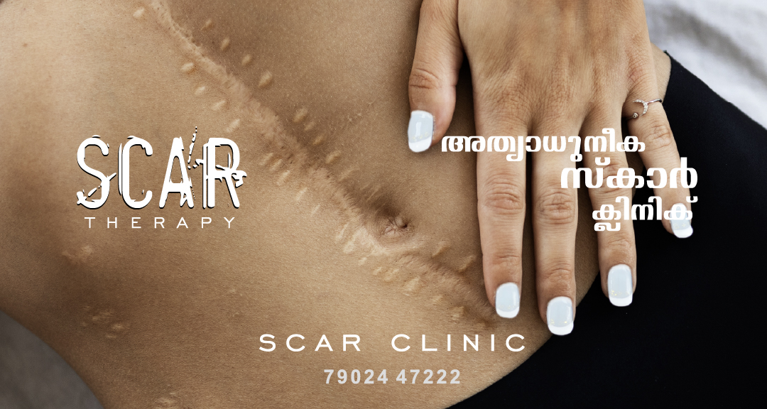 Lisa skin clinic, Calicut, Scar Therapy